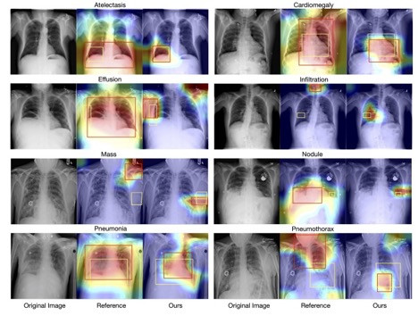 Knowledge-Augmented Contrastive Learning for Abnormality Classification and Localization in Chest X-rays with Radiomics using a Feedback Loop